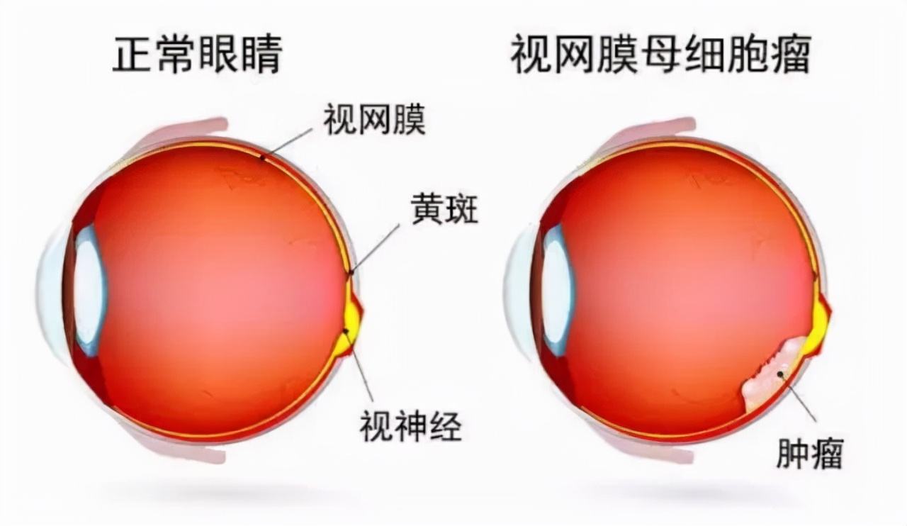 視網膜母細胞瘤常見於小孩,發展到後期,可能會導致患者失明
