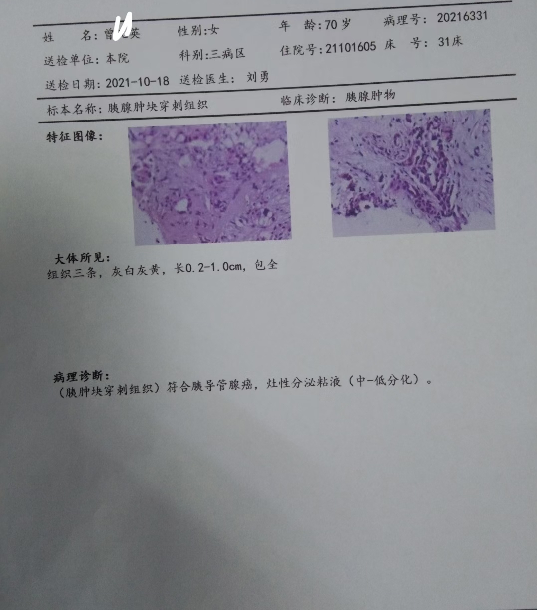 「病例分享」70岁娭毑胰头结节致胆道梗阻,穿刺活检确诊为胰腺癌