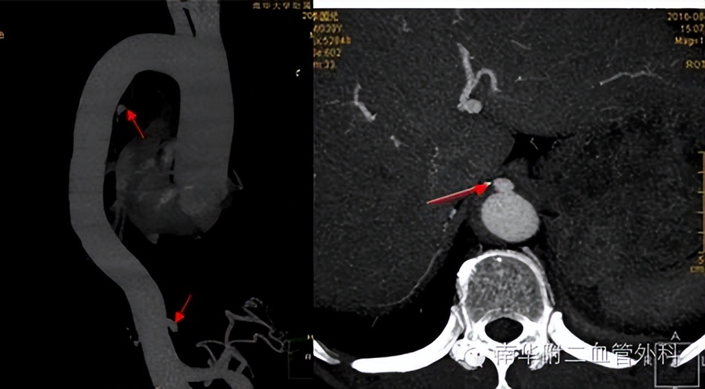 主动脉也会"溃疡"