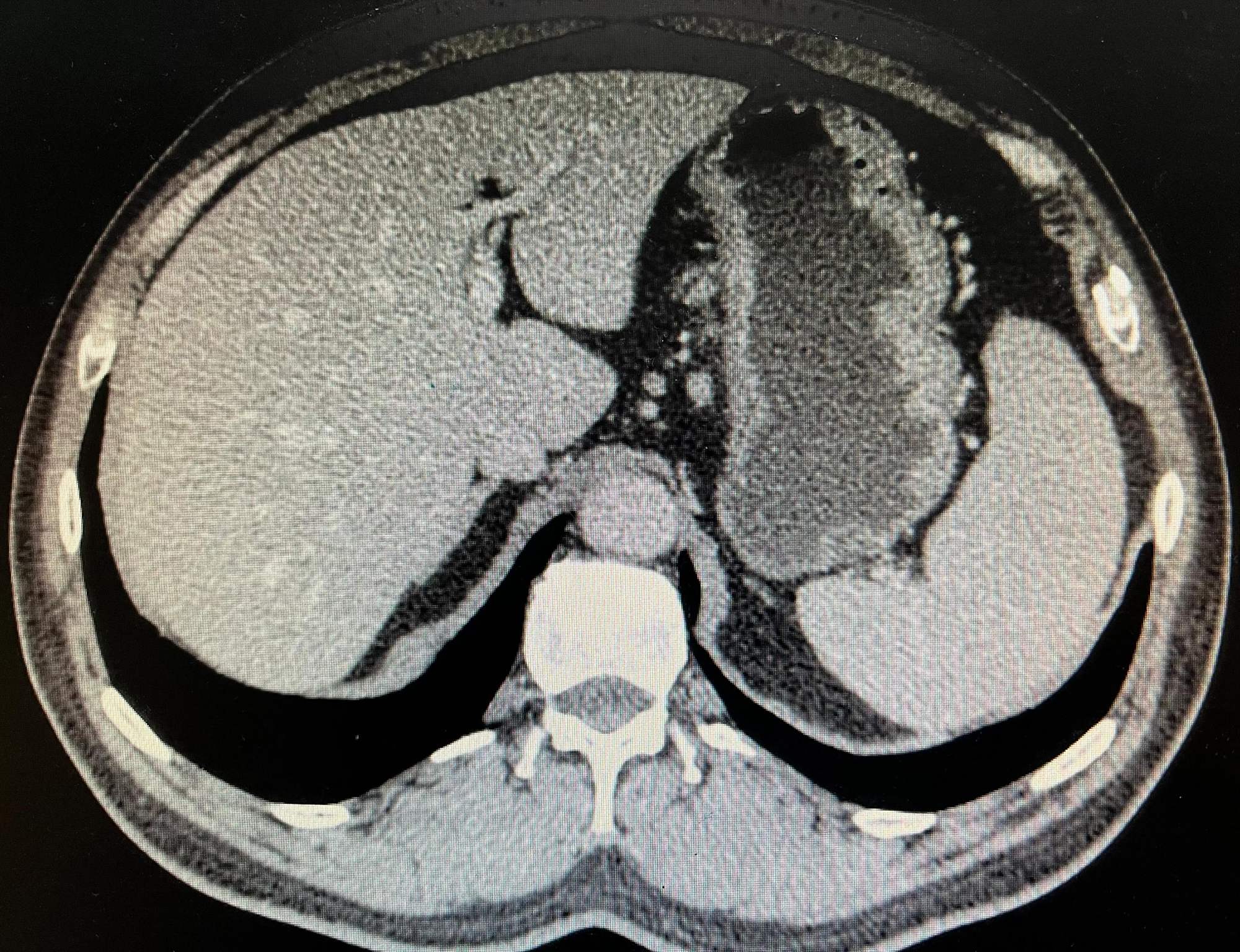 患上贲门腺癌是手术还是先化疗再手术