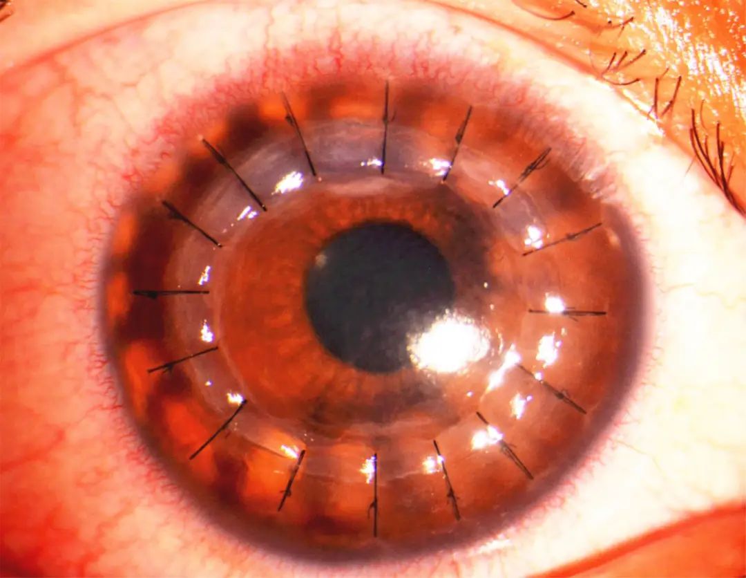 米赫人工角膜是如何填补全球眼科空白的?