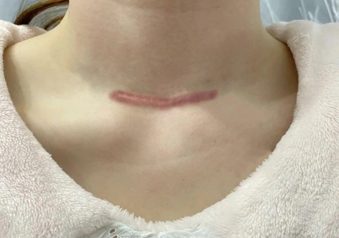 甲状腺术后疤痕增生怎么办?过来人教你一招,淡疤不复发!