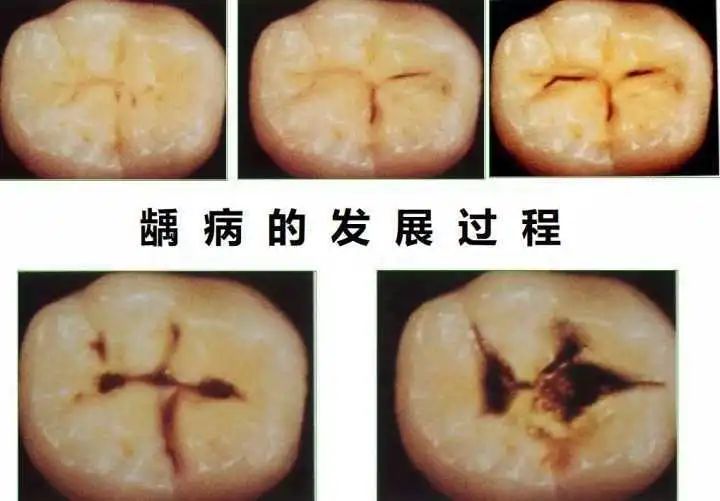 经常喝可乐的牙齿图片图片