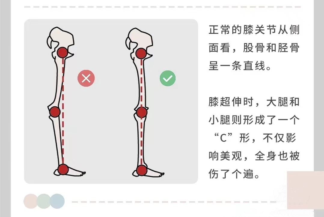 脊地小課堂|膝超伸:腿粗/肚子凸,5個動作改善腿型