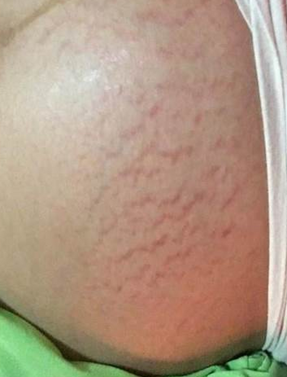 小薇今年15岁,她今年放假回家,妈妈看到女儿肚子上都是妊娠纹,而且