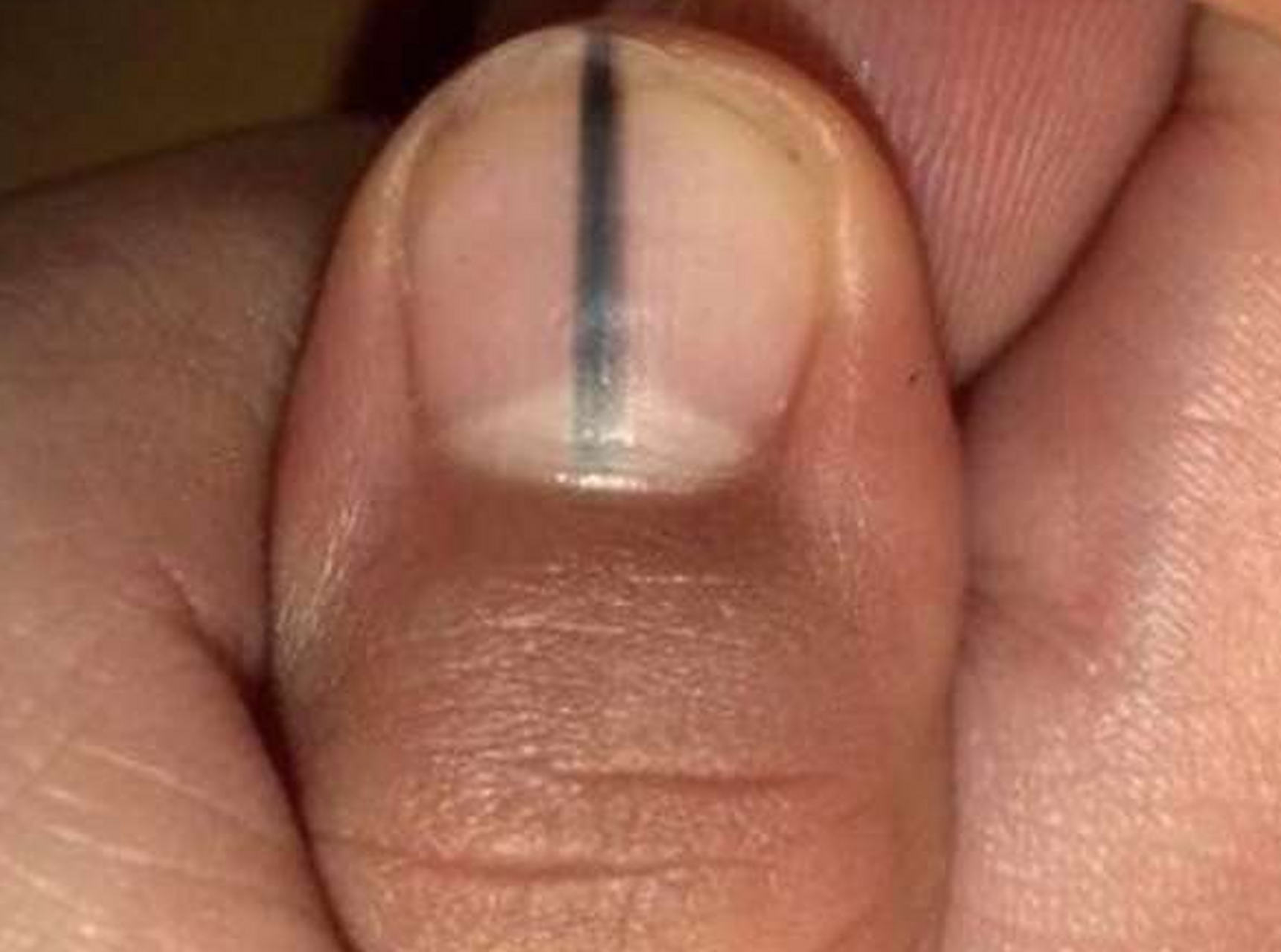 刘先生44岁,最近指甲上长了一道黑线,他发现好多人都有,也没在意,结果