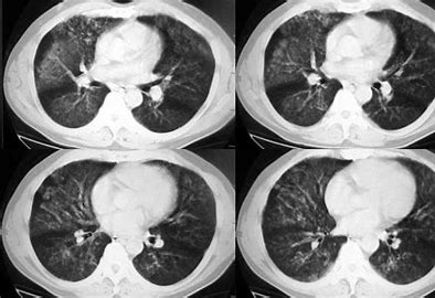 急性呼吸窘迫综合征,病死率较高,了解诊断方式才能更好配合治疗