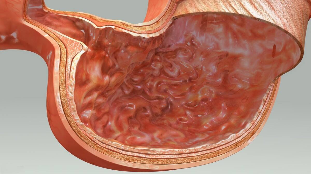 报告上写着肠上皮化生,是什么意思?与胃癌有关吗?