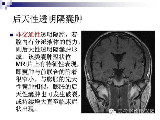 9岁儿童透明隔腔增宽图片