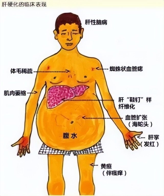 53岁男子连续4年体检,查出轻度脂肪肝最后进展成肝硬化