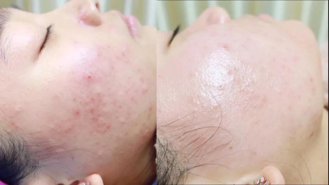 为什么会长痤疮?该怎么办?