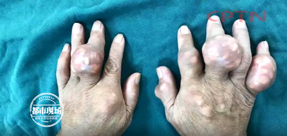 触目惊心!男子手上全是囊肿,已经严重畸变!