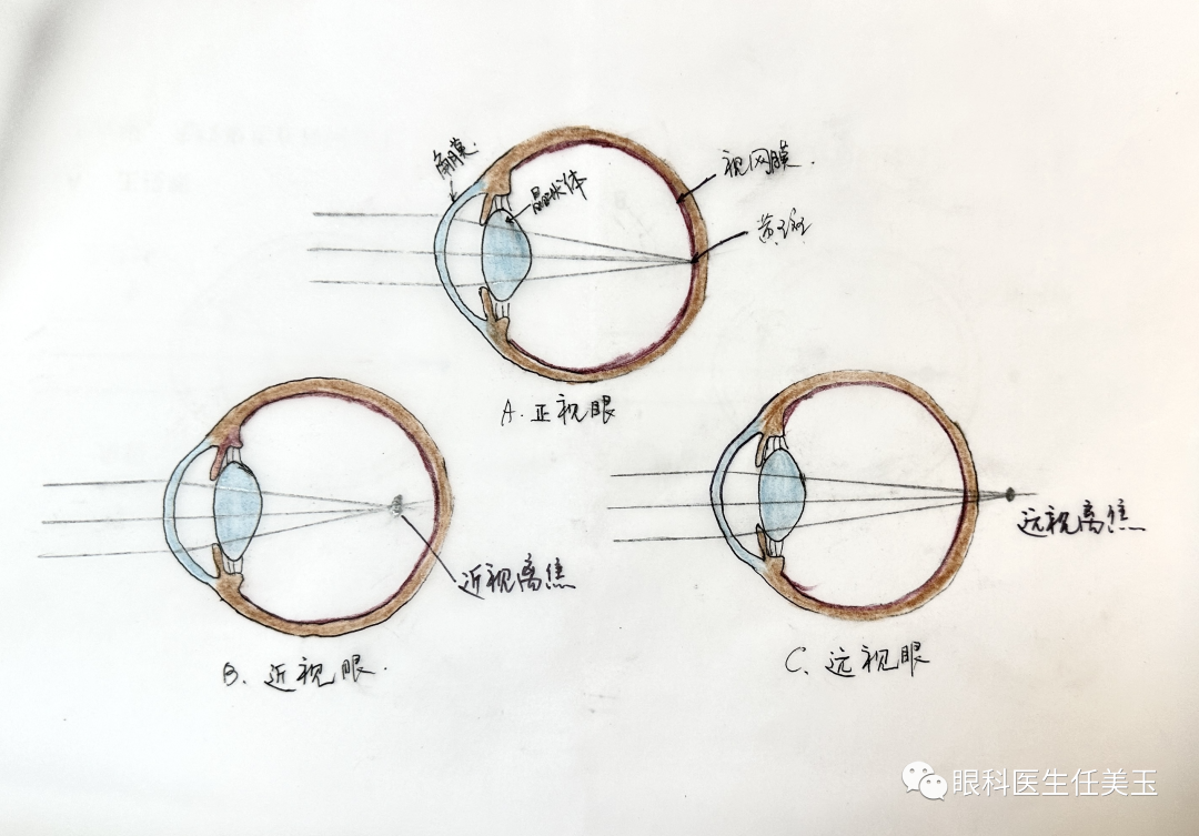 3. 什么是离焦眼镜?它是怎样控制近视发展的?