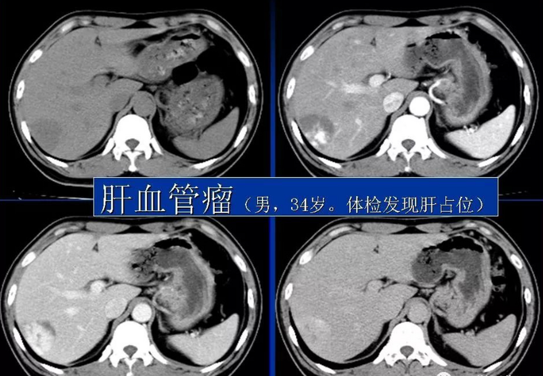 肝血管瘤真的不用管吗?