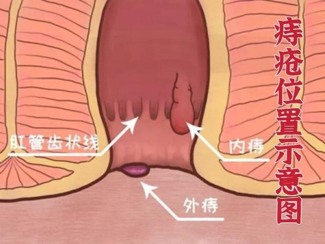 科普|痔疮内痔有哪些症状?外痔肉球怎么消?治疗痔疮,要有原则