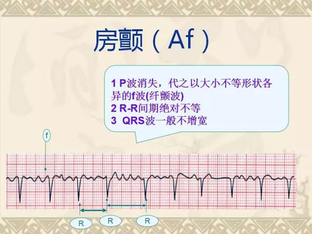 「收藏」执业医师考生必须掌握的常见异常心电图!