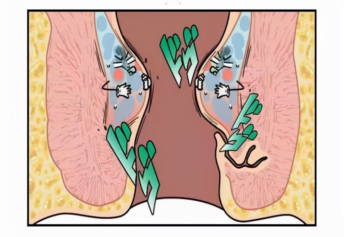 肛门白色癣的症状图片图片