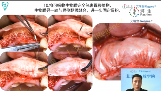 艾瑞金口腔学院-优诺口腔冯楠讲授湃生生物膜应用于水平骨增量