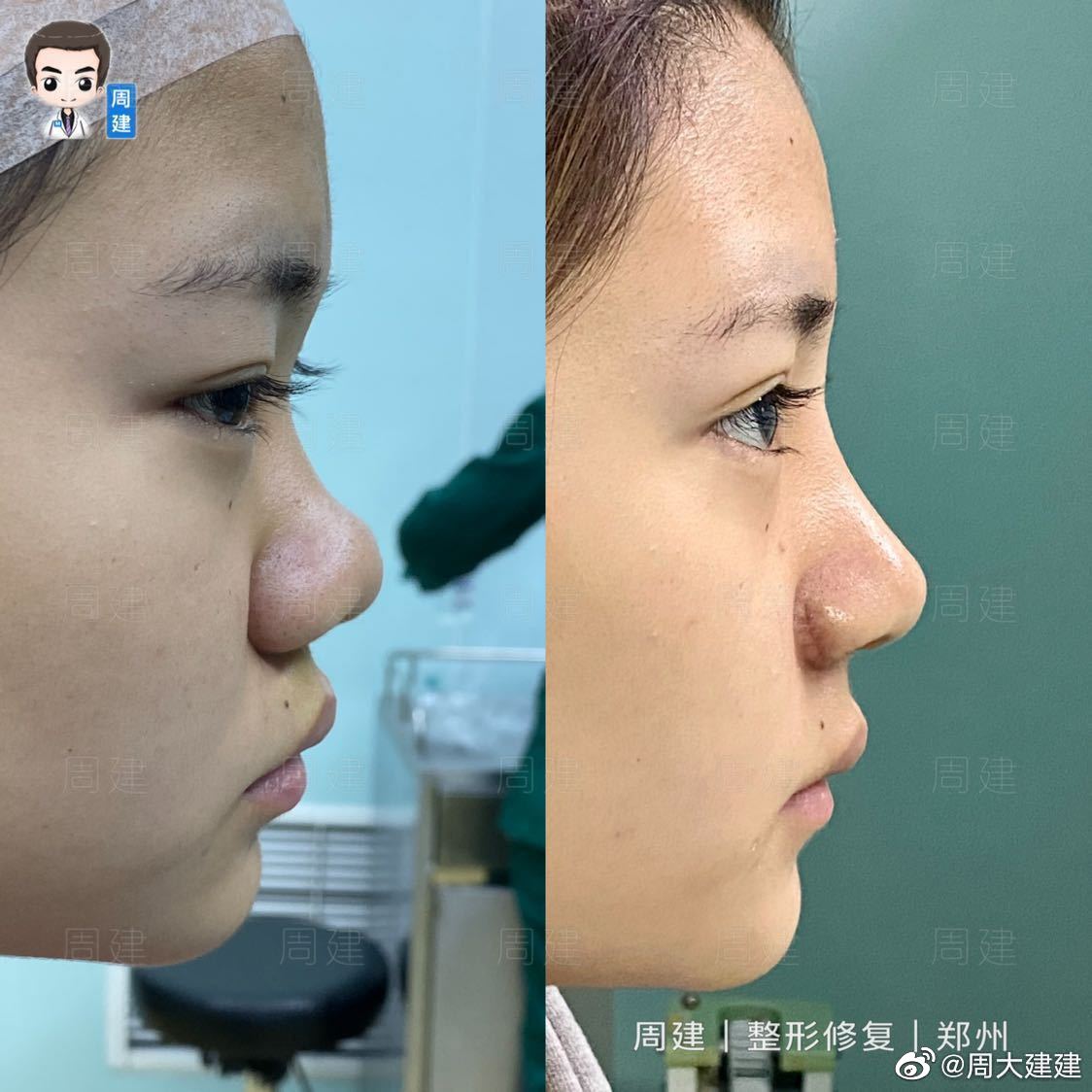 哑铃鼻基底,新术式不移位,郑州周建医生鼻整形专访