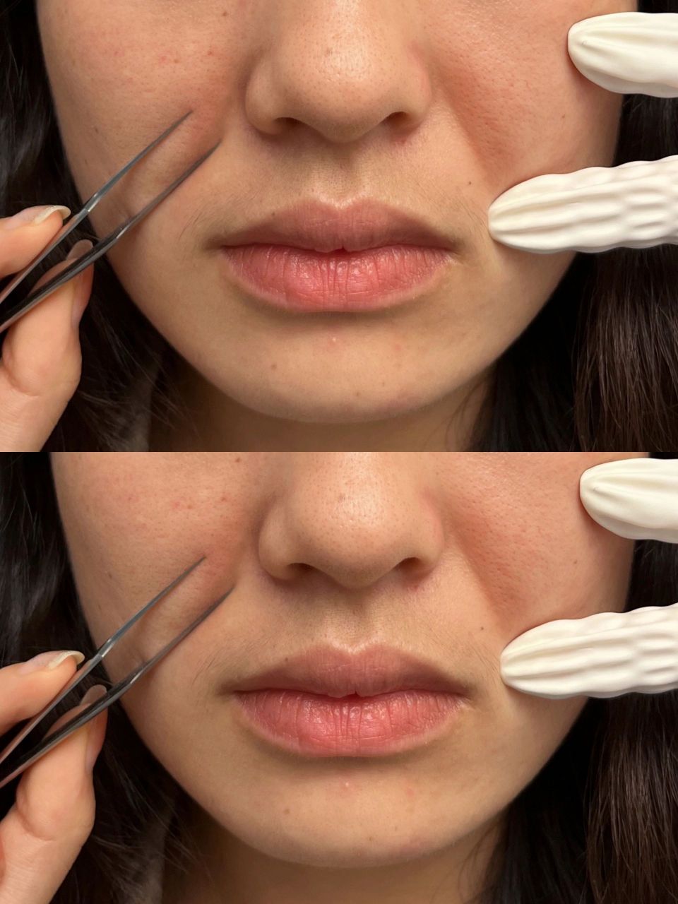 有法令纹的都去看看 总算是把我的重度法令纹搞没了!