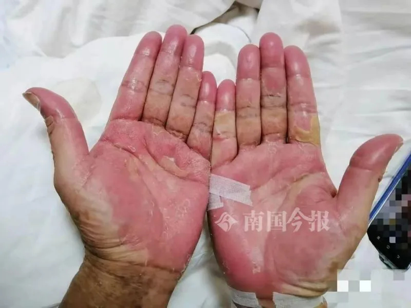 大补?蛇胆蛇血蟾蜍青蛙轮番生吃下肚,男子全身溃烂入院,命悬一线