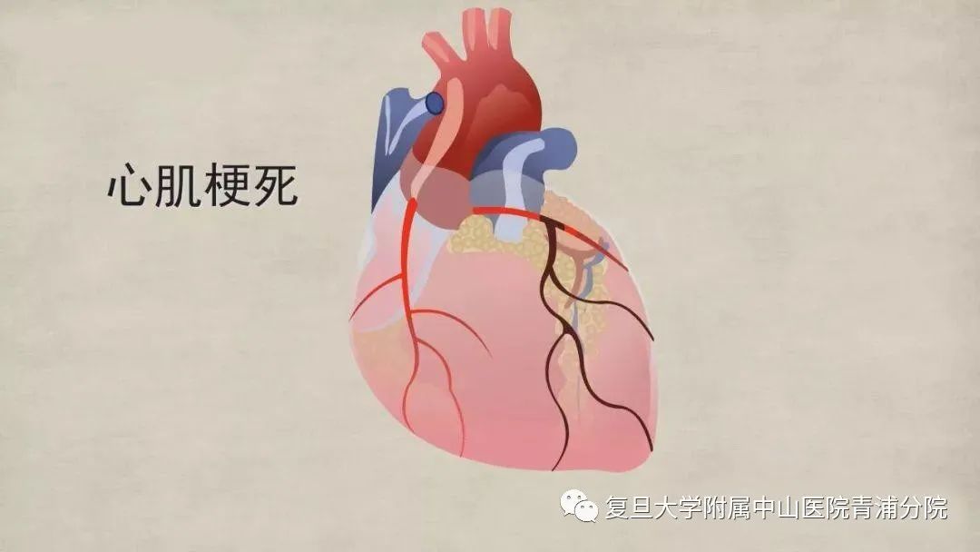 【病例夹】急性心梗之冠脉栓塞