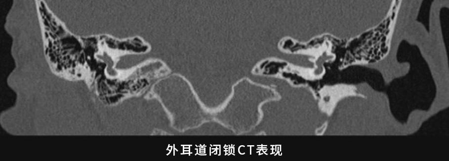 耳整形专家带你了解外耳道闭锁