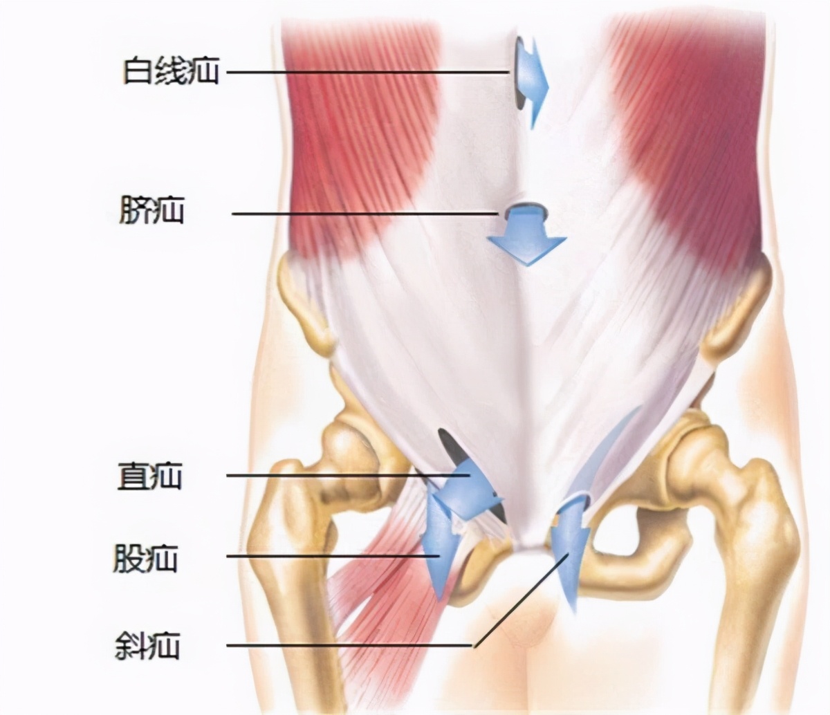 腹股沟的位置示意图图片