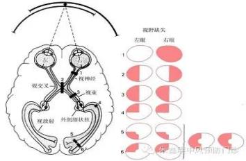 右侧偏盲图片