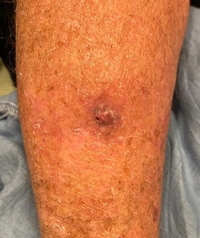 一例一病-组织细胞型黑色素瘤