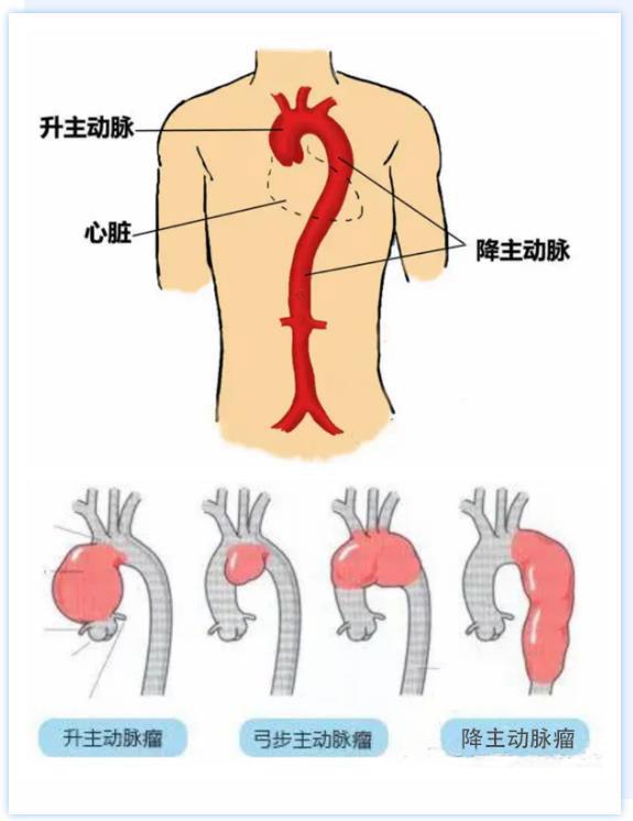 再也不用提心吊胆了常德一医专家为患者拆除心脏主动脉拳头大小定时