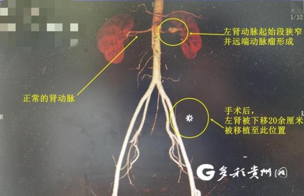 贵州首例!贵医附院成功实施自体肾移植手术