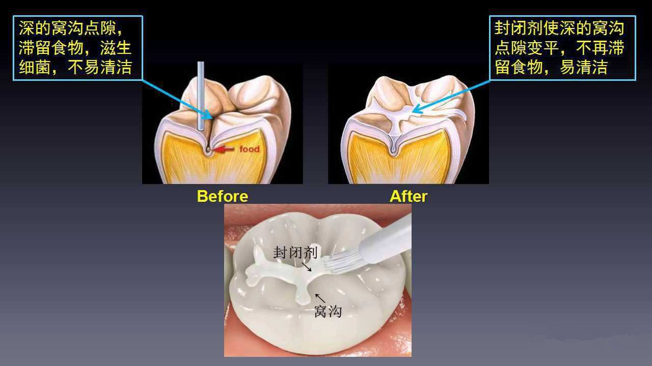 窝沟封闭有必要吗图片