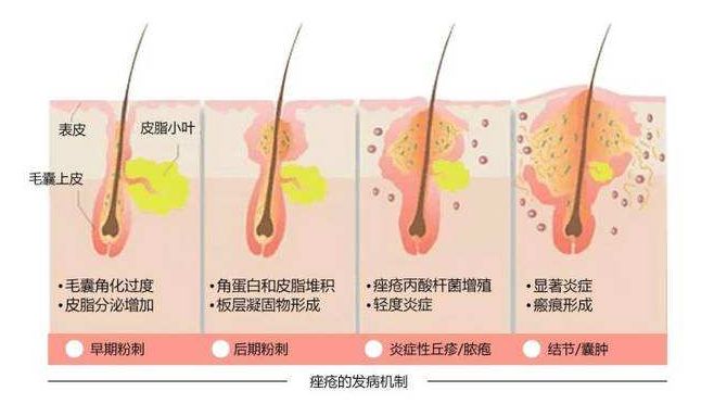 「皮肤科」痤疮的发病机制