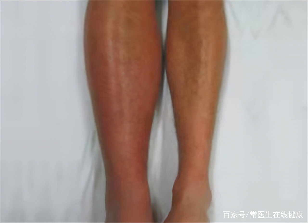 试管移植后静脉血栓症状(试管移植后静脉血栓症状多久消失)-第2张图片-鲸幼网