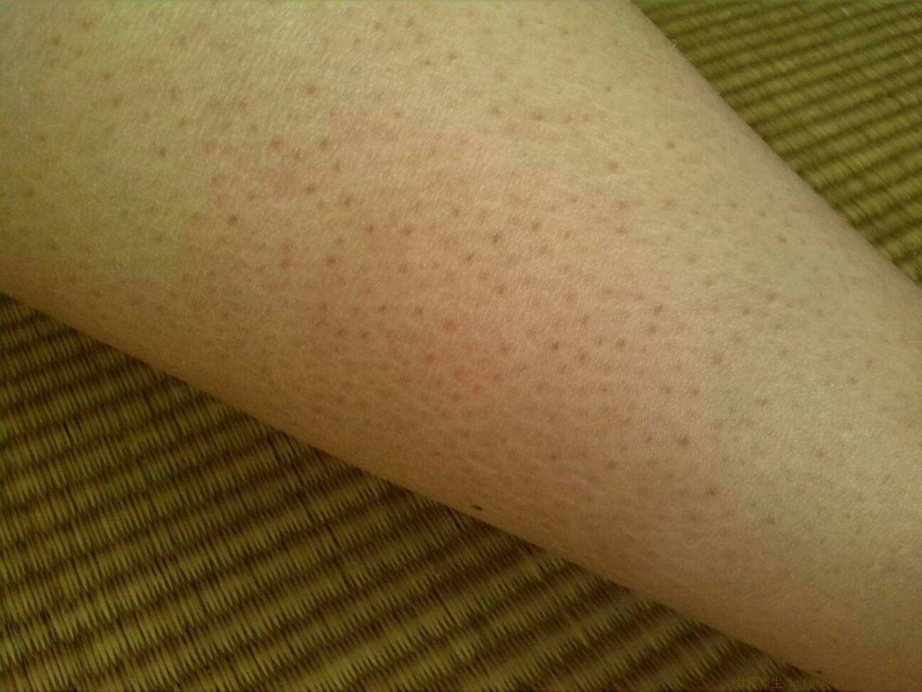 鸡皮肤巨痒(鸡皮肤夏天痒)