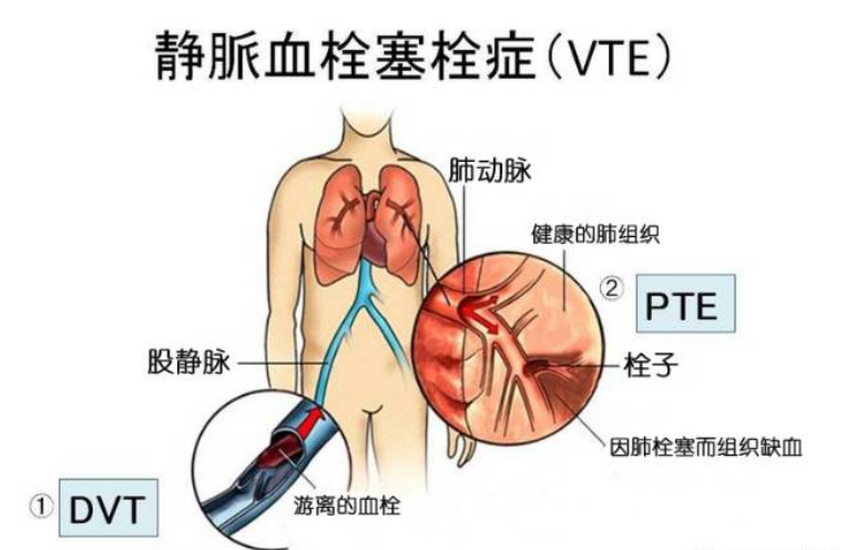 肺栓塞图片 示意图图片