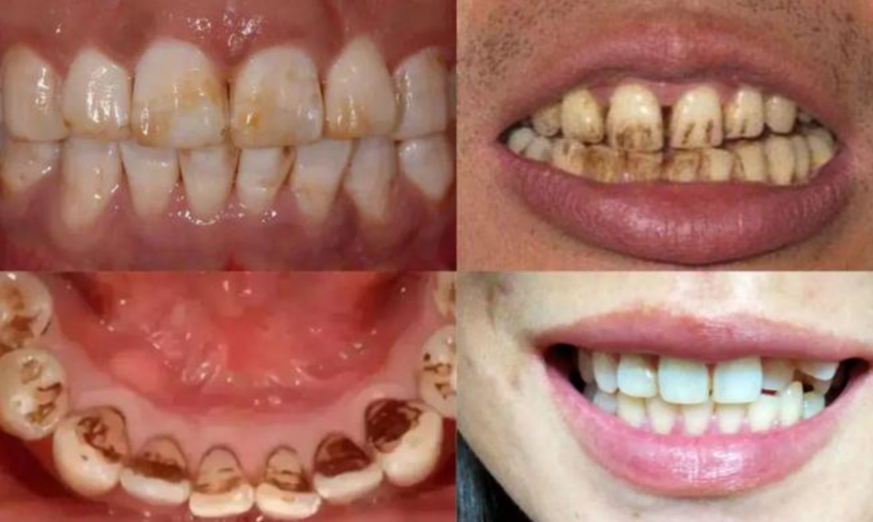 牙齿不好,往往会出现6个症状,一个不占,牙齿还算健康
