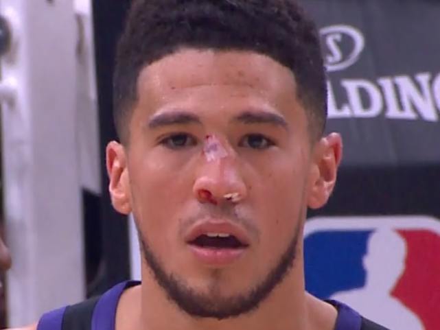 布克鼻梁骨被撞成s状,基本可以判定是骨折,g3他决定带面具打球