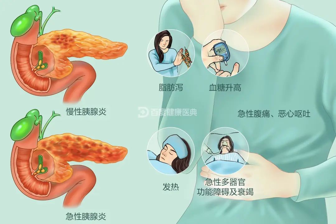 脂源性胰腺炎 baijiahao.baidu.com