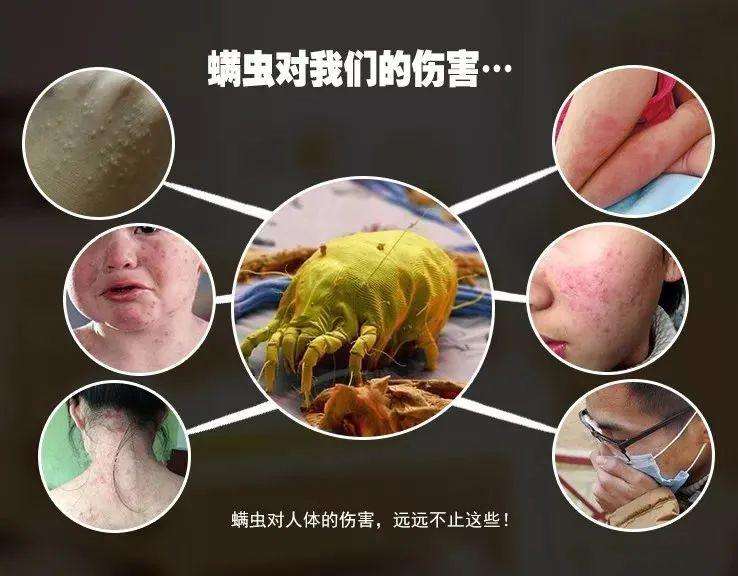 被螨虫叮咬后可以引起螨虫皮炎,因为螨虫皮炎多发生