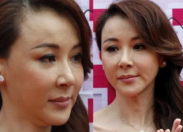 "最丑紫薇"又整容,脸部僵硬表情不自然,琼女郎们相继整容