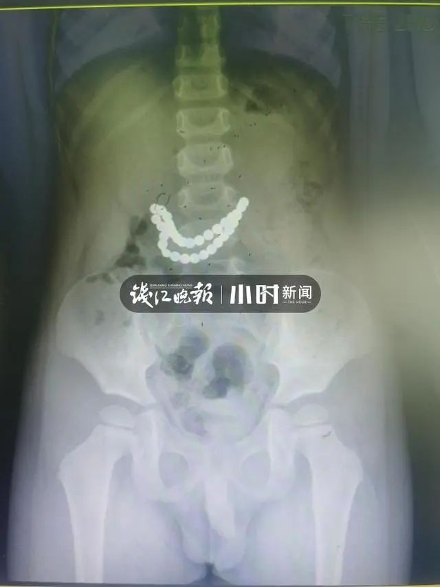 热点|整整32颗!3岁男孩肚子被打开,医生揪心不已:家长真的别乱买
