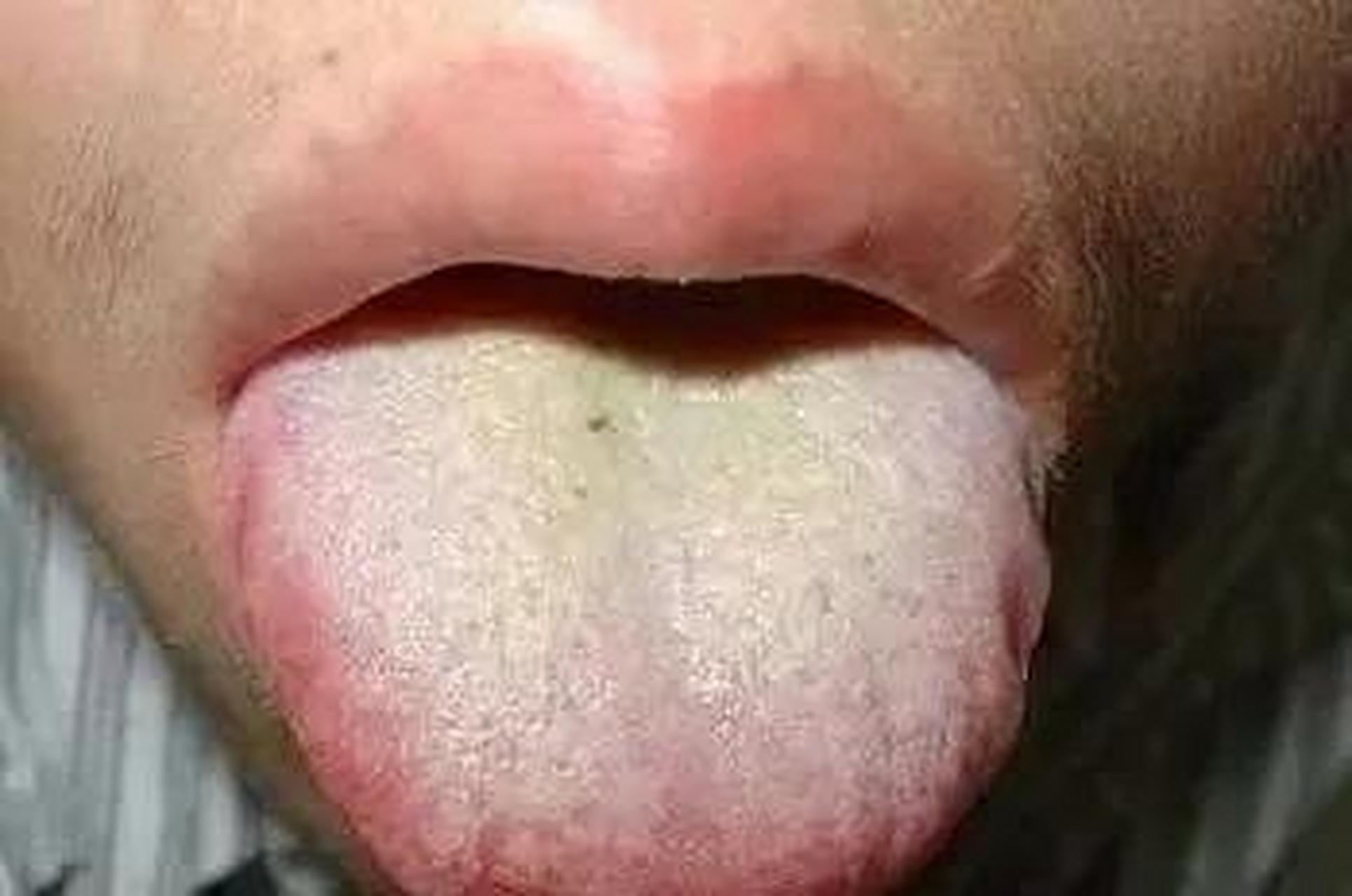 舌苔黄腻,身体有痰热,说一个方来应对 舌红苔黄腻这类人往往多见是痰