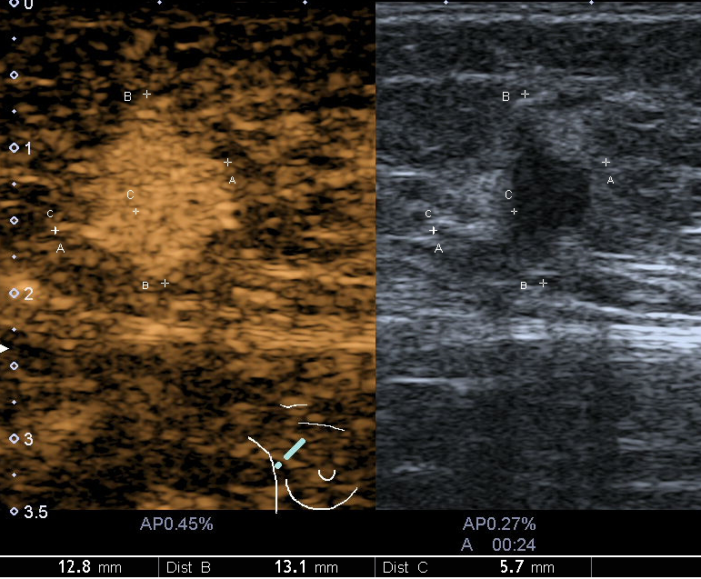 不打针,不开刀 超声造影鉴别甲状腺结节"良恶"