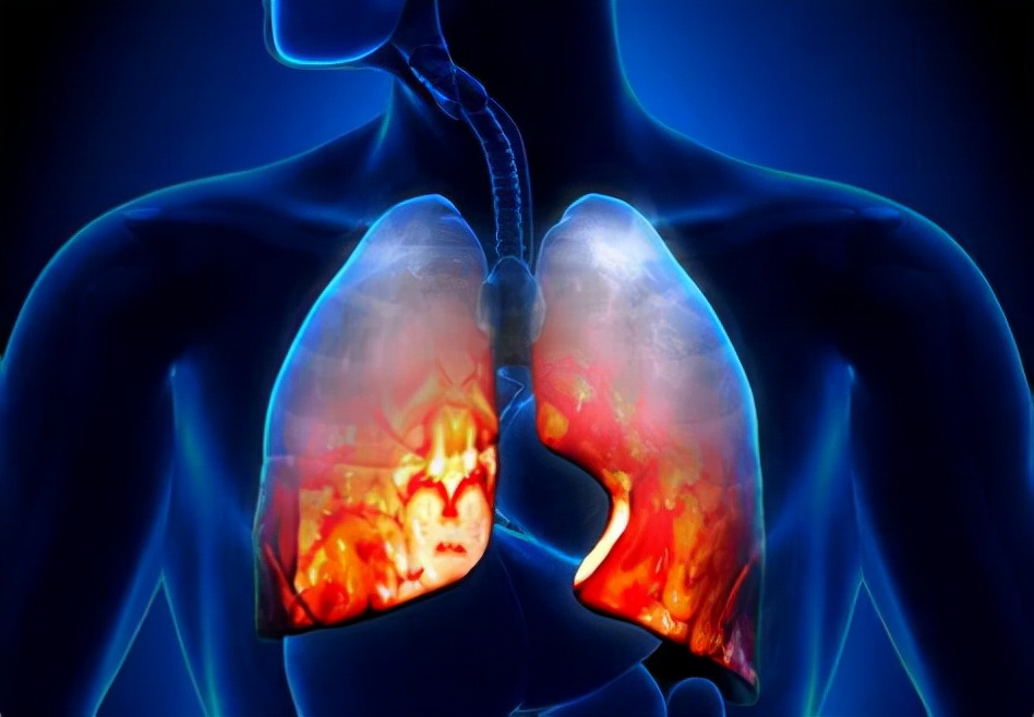 什么是吸入性肺炎?什么样的人群容易患这种肺炎