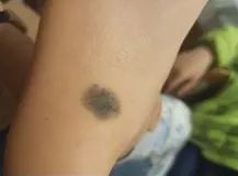 推荐速低头，找痣！知名医生：长在这些地方的都要切除！