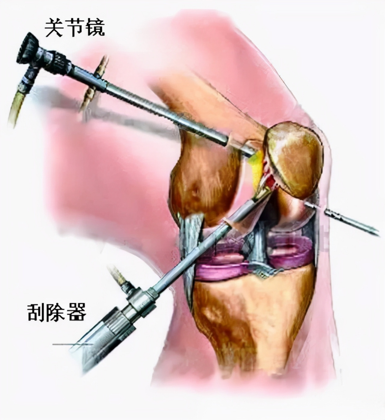 小儿急性化脓性关节炎,可见于各年龄段儿童,男孩患病较多