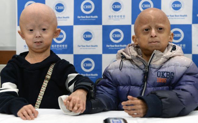 中国早衰症儿童图片图片