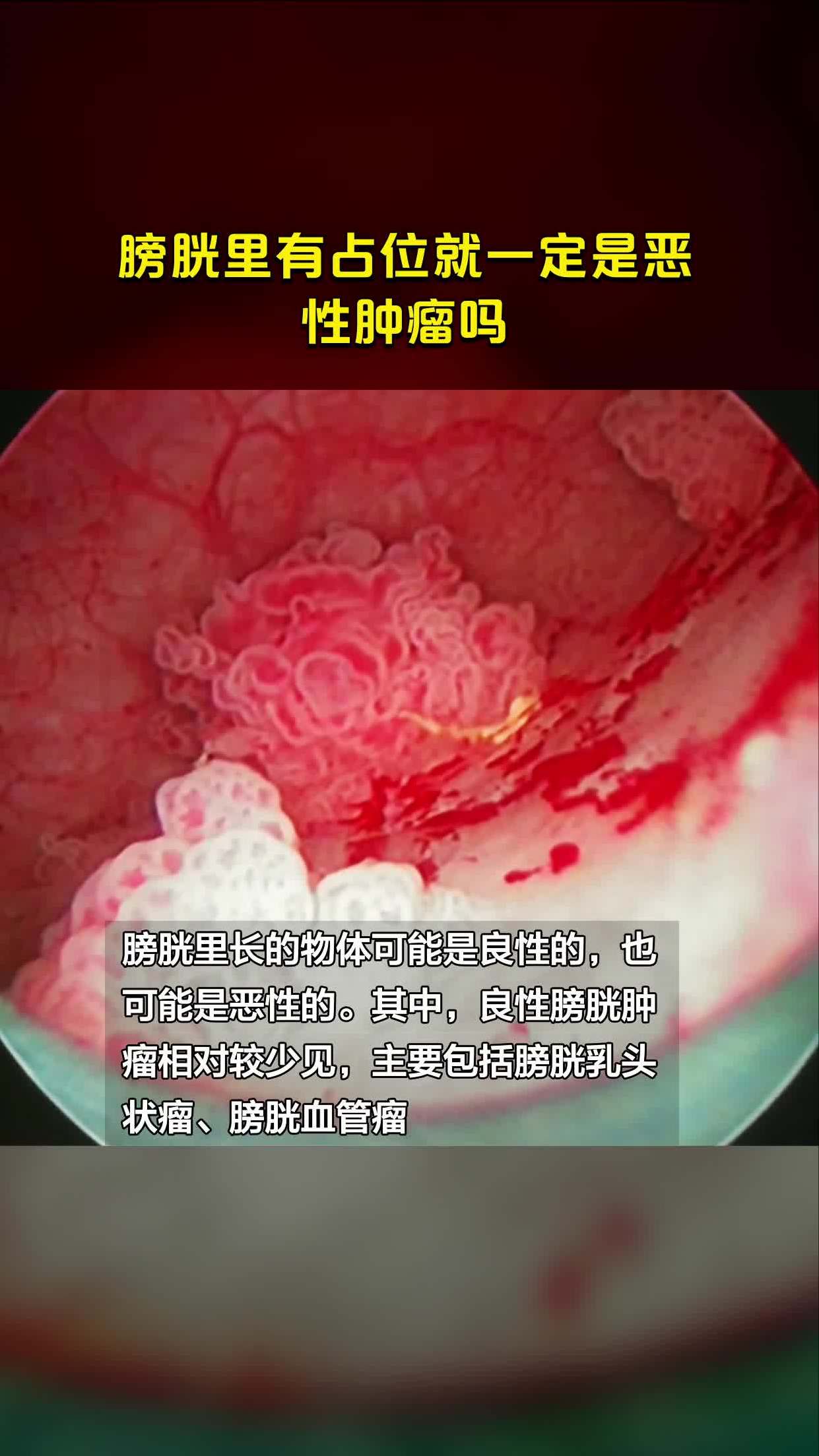 膀胱里有占位就一定是恶性肿瘤吗